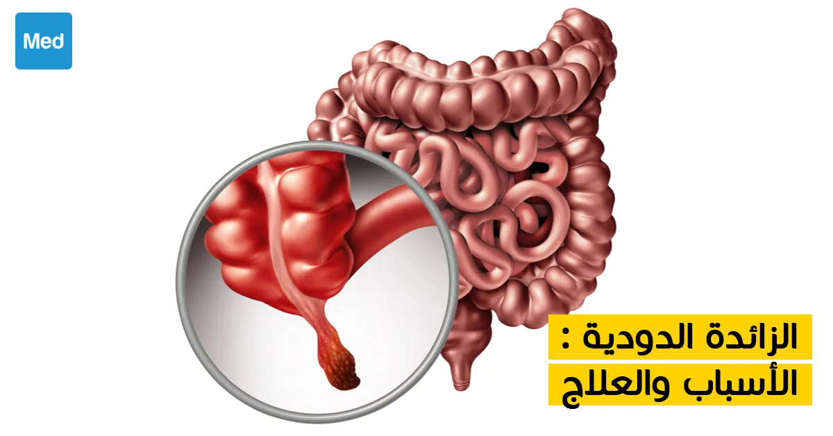 الزائدة الدودية : الأسباب والعلاج